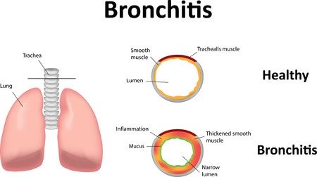 Bronchitis