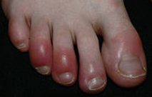 Chilblains