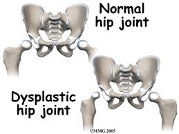 Developmental Dysplasia of the hip (DDH)