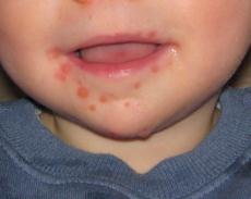 Hand, Foot and Mouth Disease
