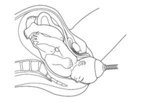 Assisted Birth – Ventouse and Forceps