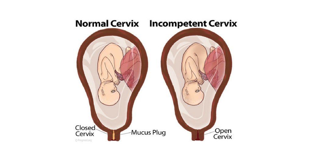 Incompetent Cervix