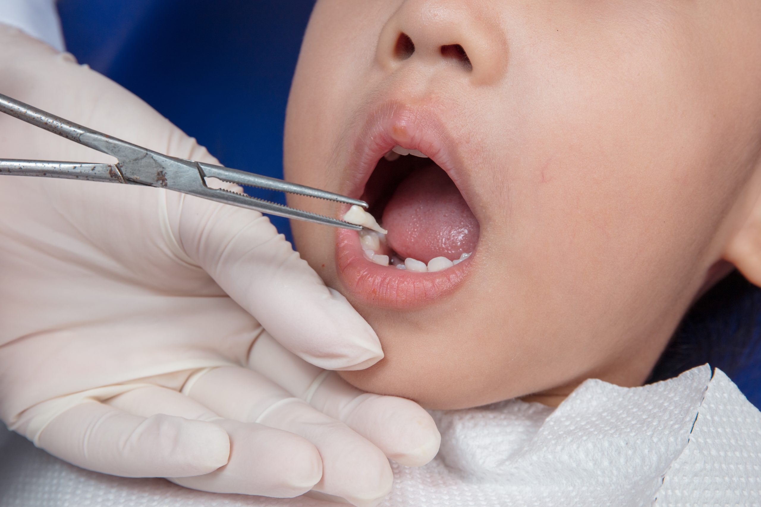 7 Ways To Prepare Your Child For Their First Tooth Extraction